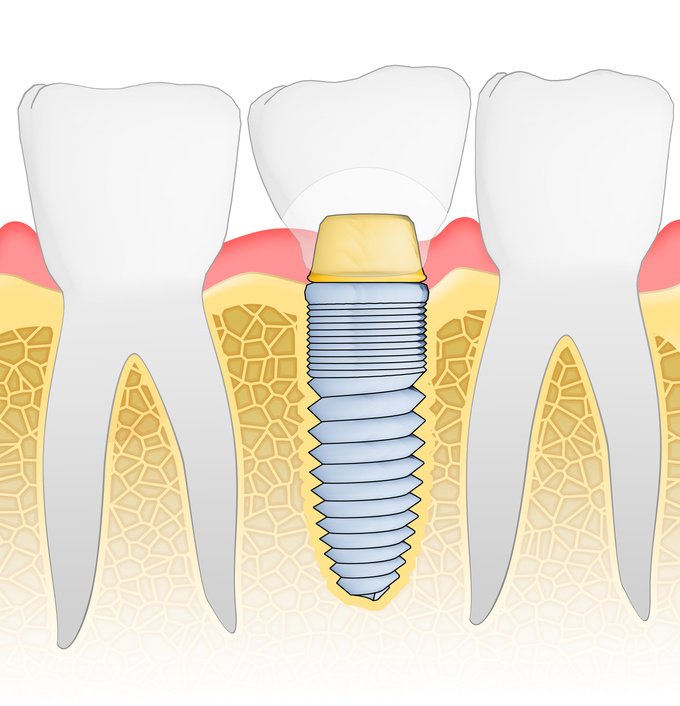 implant